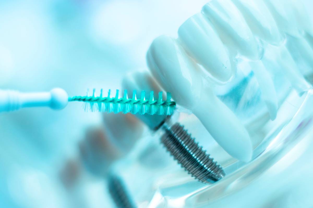 concept of how to clean your dental implants